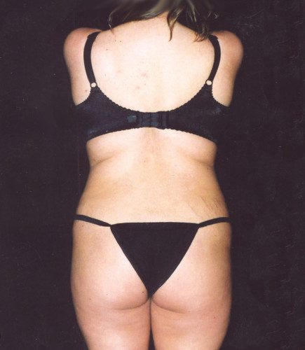 Abdominoplasty Before & After Image