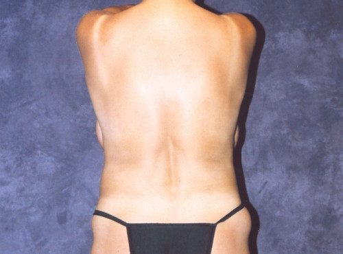 Abdominoplasty Before & After Image