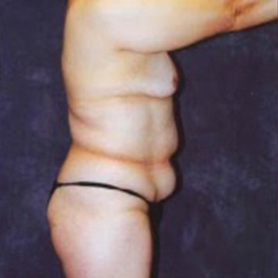 Abdominoplasty Before & After Image