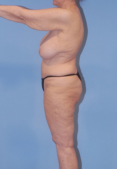 Abdominoplasty Before & After Image