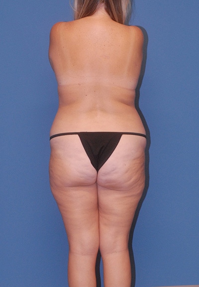 Abdominoplasty Before & After Image