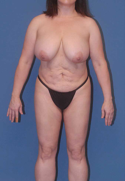 Abdominoplasty Before & After Image