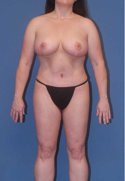 Abdominoplasty Before & After Image