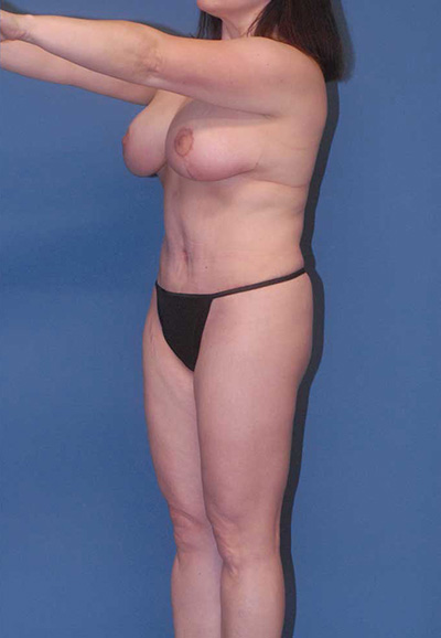 Abdominoplasty Before & After Image