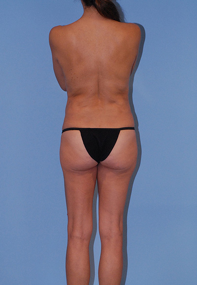 Abdominoplasty Before & After Image
