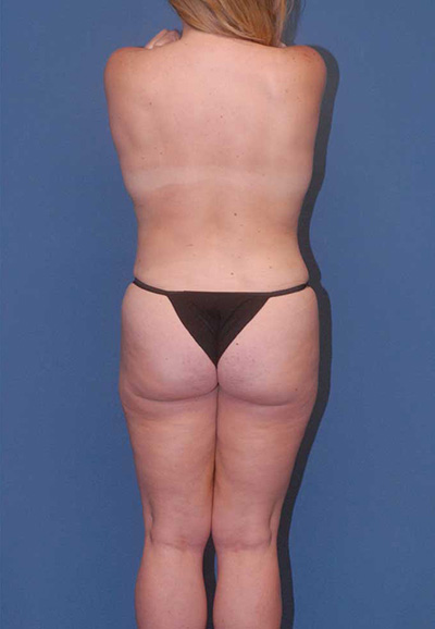 Abdominoplasty Before & After Image