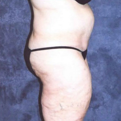 Abdominoplasty Before & After Image