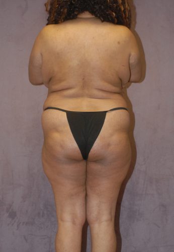 Abdominoplasty Before & After Image