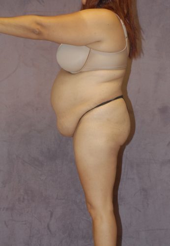 Abdominoplasty Before & After Image