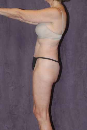 Abdominoplasty Before & After Image