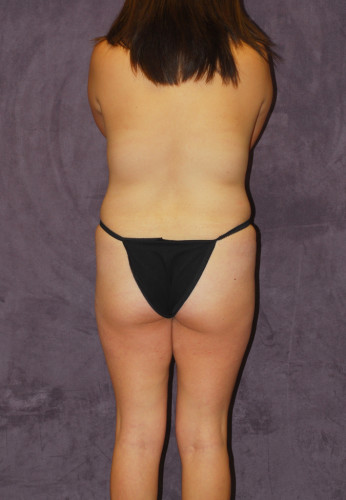 Abdominoplasty Before & After Image