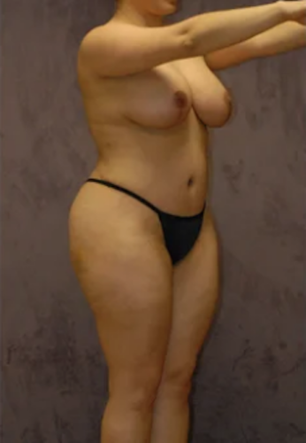 Abdominoplasty Before & After Image