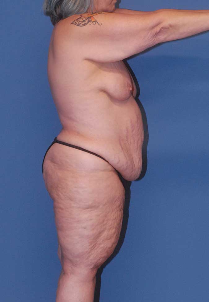 Abdominoplasty Before & After Image