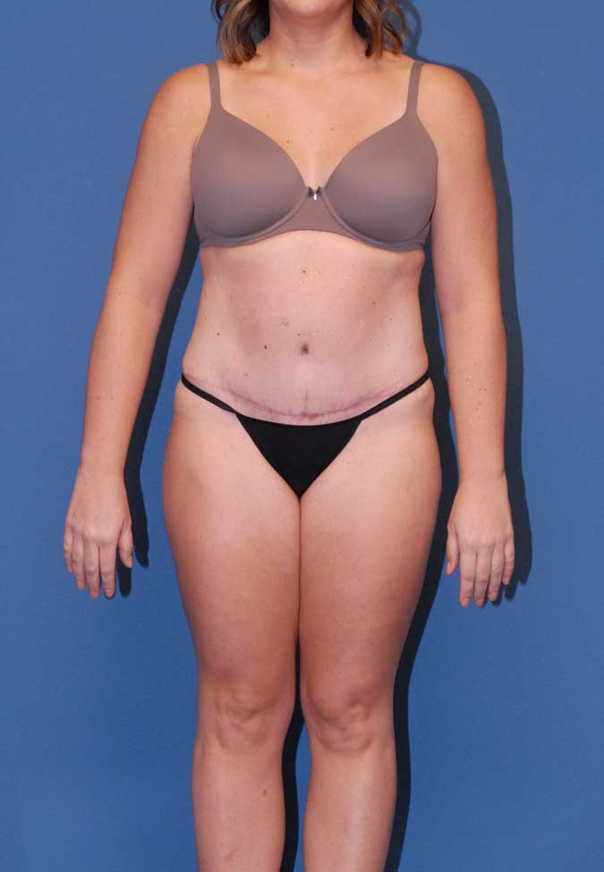 Abdominoplasty Before & After Image