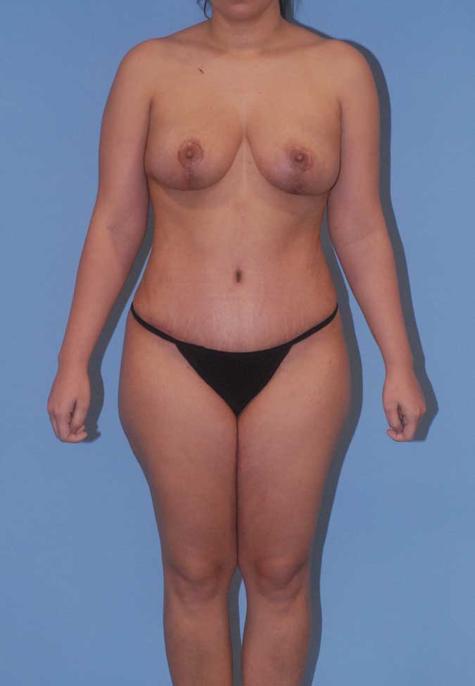 Abdominoplasty Before & After Image