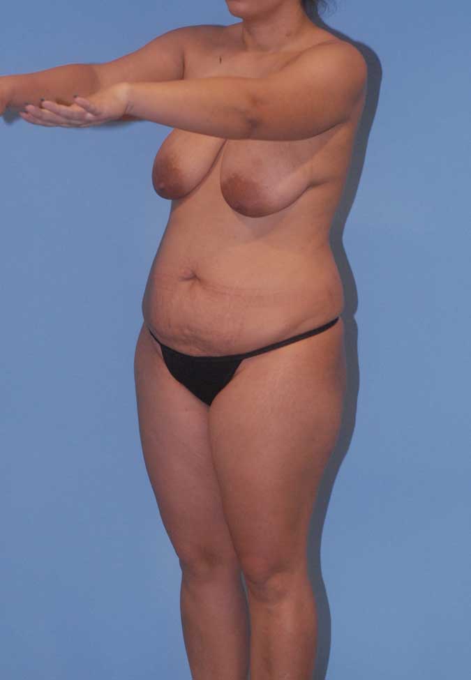 Abdominoplasty Before & After Image