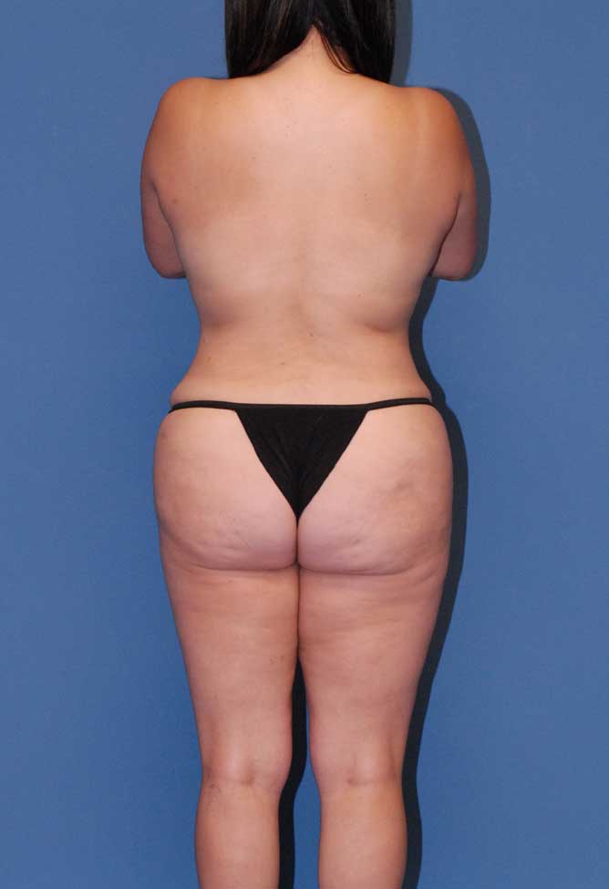 Abdominoplasty Before & After Image