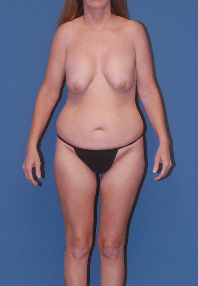 Abdominoplasty Before & After Image