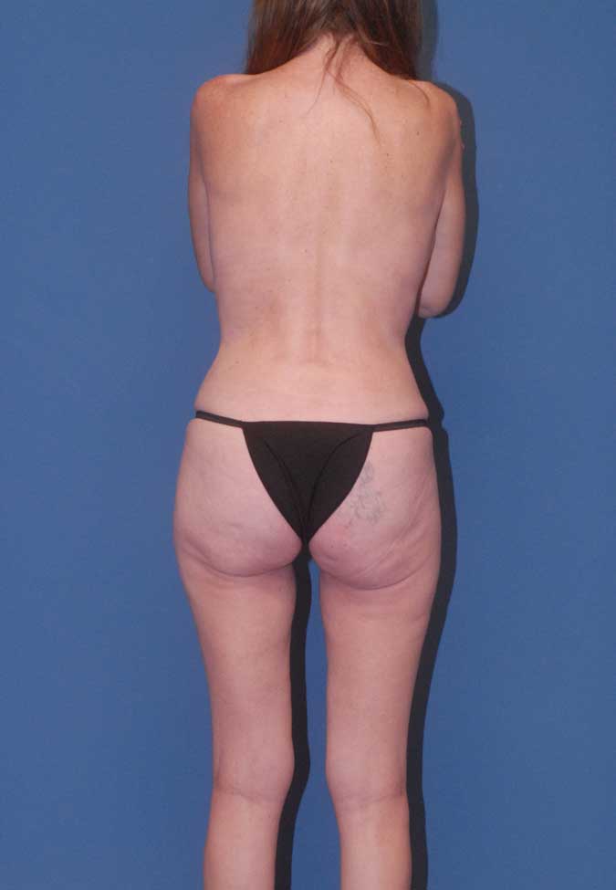 Abdominoplasty Before & After Image