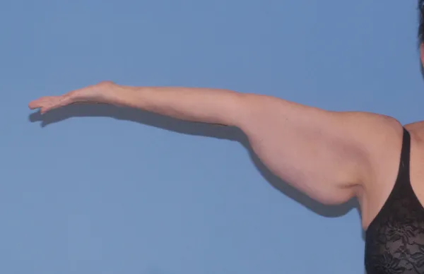 Arm Lift Before & After Image