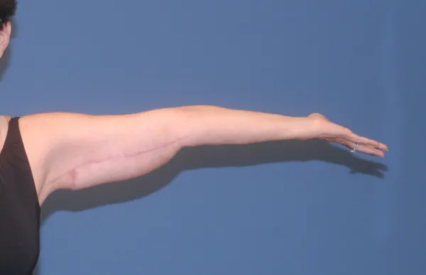 Arm Lift Before & After Image