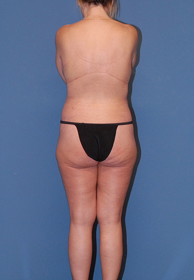 Body Lift Before & After Image