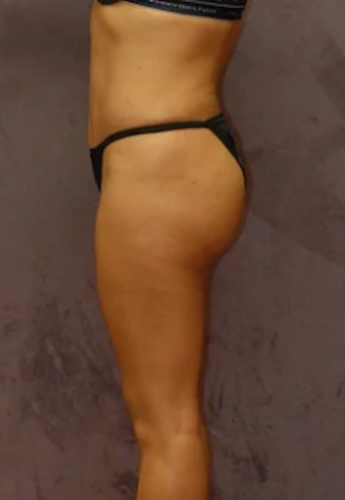 Brazilian Butt Lift Before & After Image