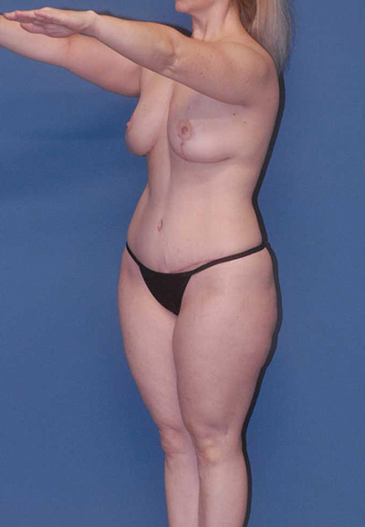 Brazilian Butt Lift Before & After Image