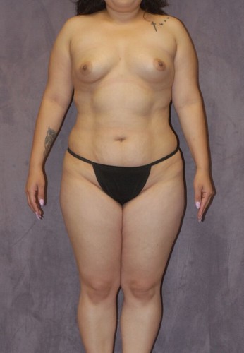 Brazilian Butt Lift Before & After Image