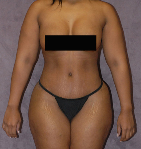 Brazilian Butt Lift Before & After Image