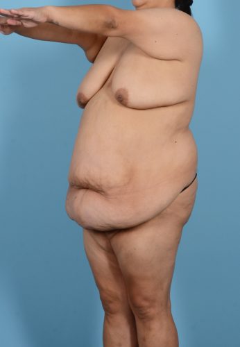 Brazilian Butt Lift Before & After Image