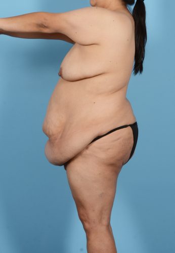 Brazilian Butt Lift Before & After Image