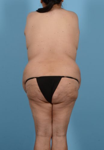 Brazilian Butt Lift Before & After Image