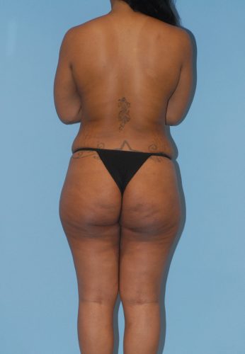 Brazilian Butt Lift Before & After Image
