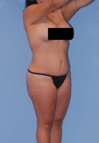 Brazilian Butt Lift Before & After Image