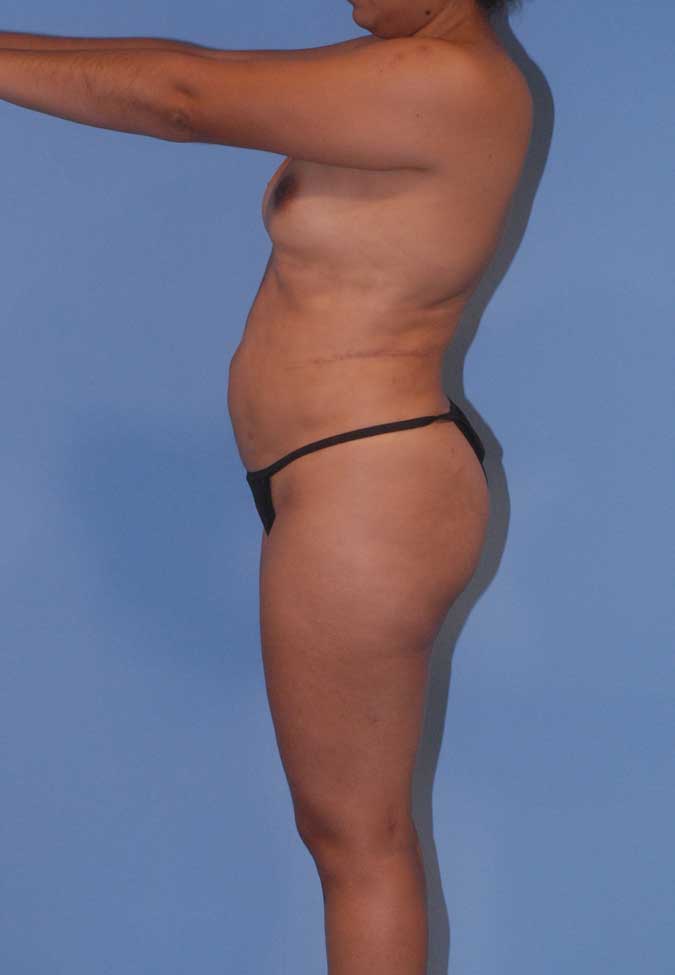 Brazilian Butt Lift Before & After Image