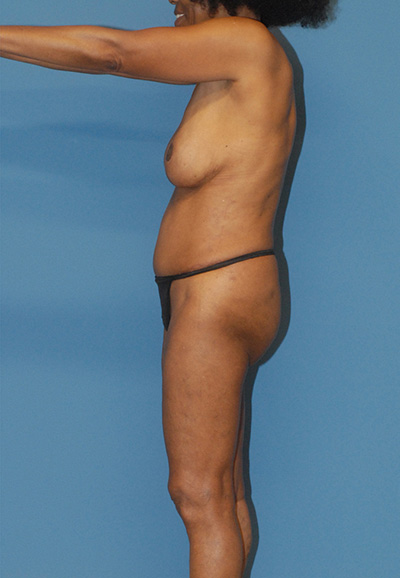 Brazilian Butt Lift Before & After Image