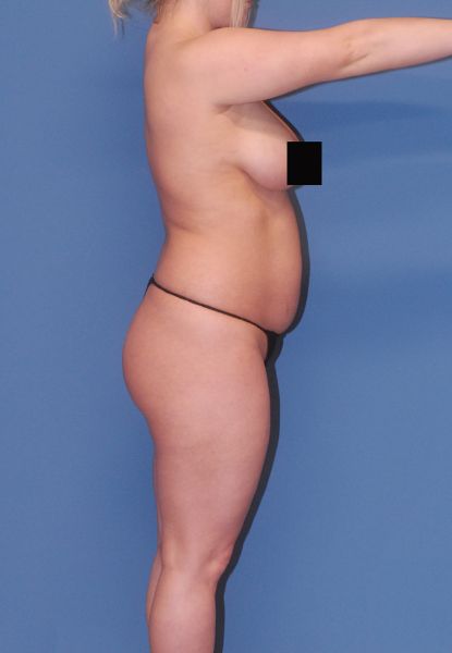 Fortes Figure Before & After Image