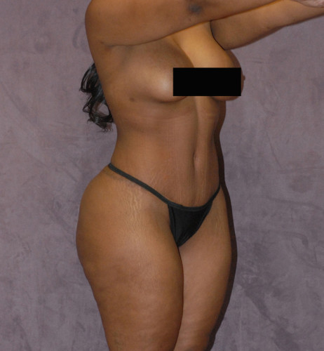 Liposuction Before & After Image