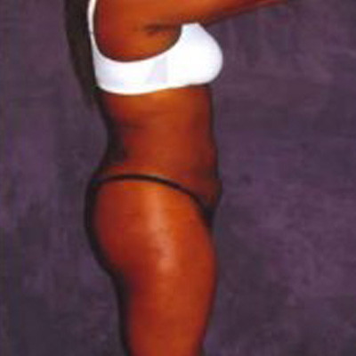 Liposuction Before & After Image