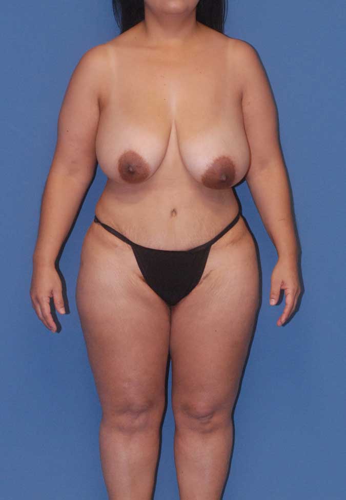 Liposuction Before & After Image