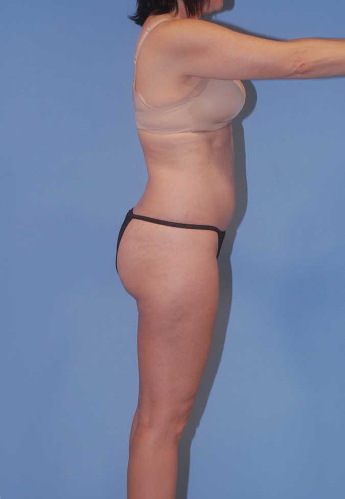 Liposuction Before & After Image