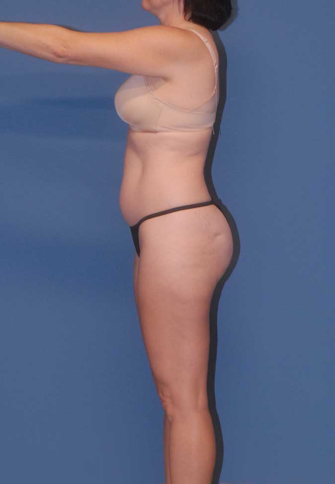 Liposuction Before & After Image