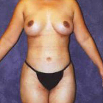 Liposuction Before & After Image