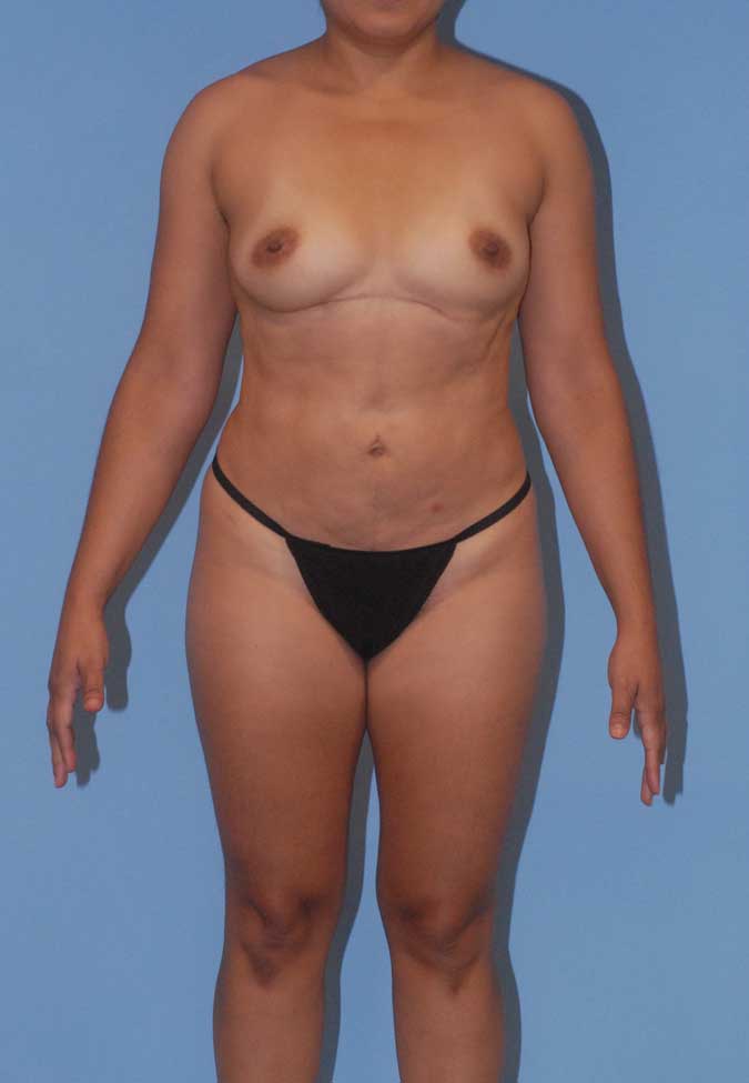 Liposuction Before & After Image