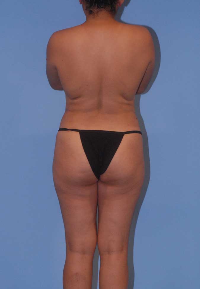 Liposuction Before & After Image