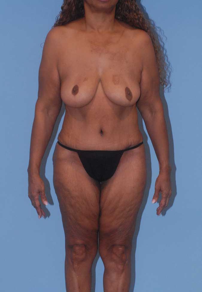 Liposuction Before & After Image