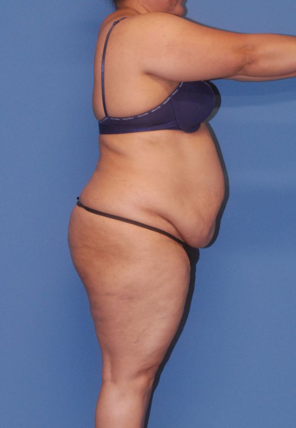 Liposuction Before & After Image