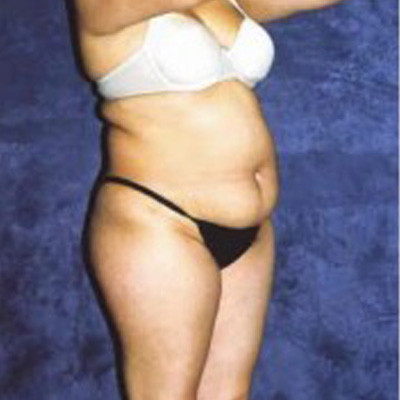 Liposuction Before & After Image