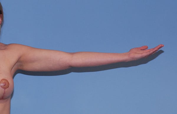 Liposuction Before & After Image